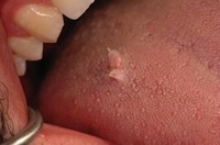 Human papillomavirus under tongue
