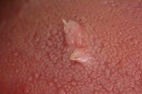 Papilloma peduncolato gola
